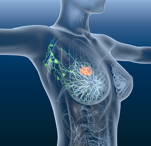 Supercomputing is helping to improve breast cancer treatments